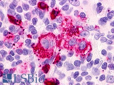 RAIG2 / GPRC5B Antibody - Hodgkin's lymphoma