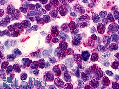 RAIG2 / GPRC5B Antibody - Non-Hodgkin's lymphoma