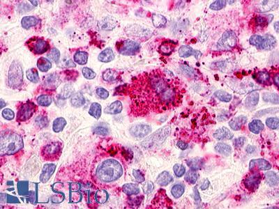 RAIG2 / GPRC5B Antibody - Hodgkin's lymphoma