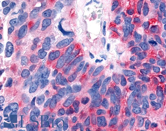 RORB / ROR Beta Antibody - Anti-RORB / ROR Beta antibody IHC of human Lung, Small Cell Carcinoma. Immunohistochemistry of formalin-fixed, paraffin-embedded tissue after heat-induced antigen retrieval.