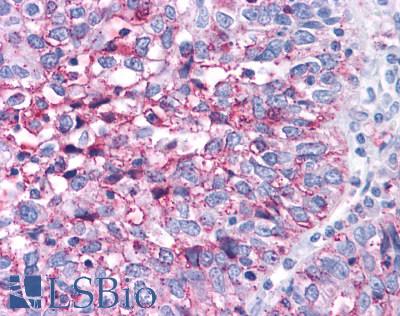 RORC / ROR Gamma Antibody - Ovary, Carcinoma