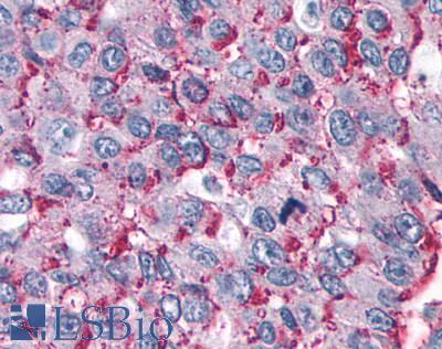 RORC / ROR Gamma Antibody - Lung, non small cell carcinoma