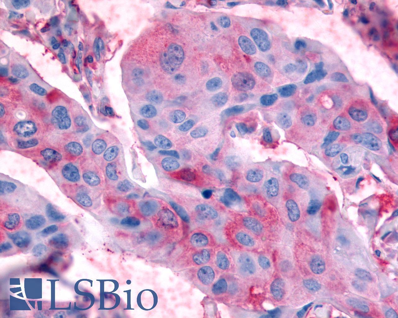 RXFP2 / LGR8 Antibody - Breast, carcinoma