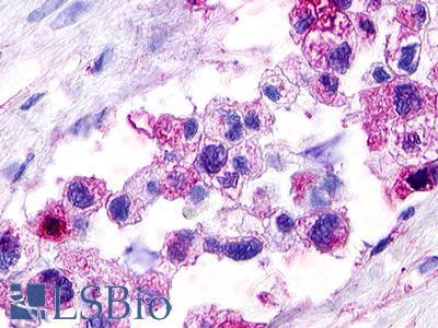 RXFP4 / GPR100 Antibody - Pancreas, carcinoma