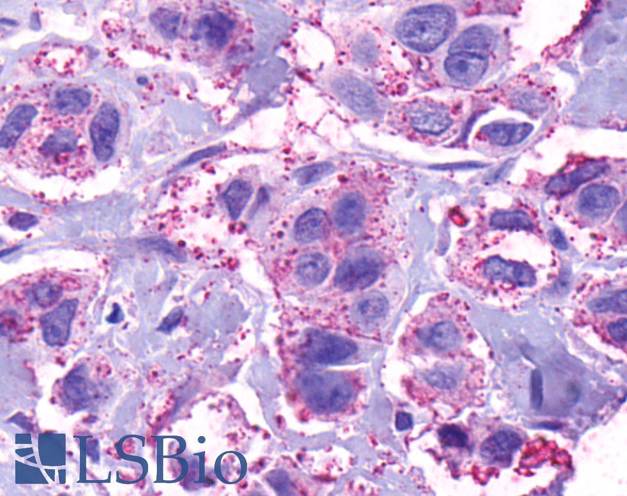RXFP4 / GPR100 Antibody - Breast, Carcinoma