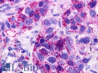 S1PR1 / EDG1 / S1P1 Antibody - Breast, Carcinoma