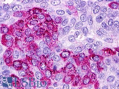 S1PR1 / EDG1 / S1P1 Antibody - Ovary, carcinoma
