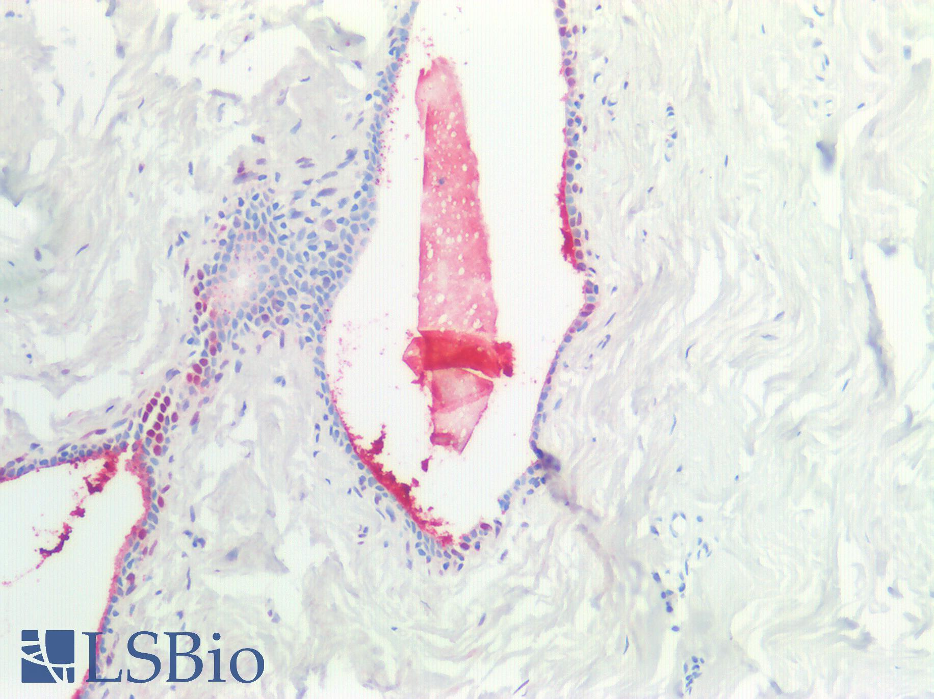 SCGB2A2 / Mammaglobin A Antibody - Human Breast: Formalin-Fixed, Paraffin-Embedded (FFPE)