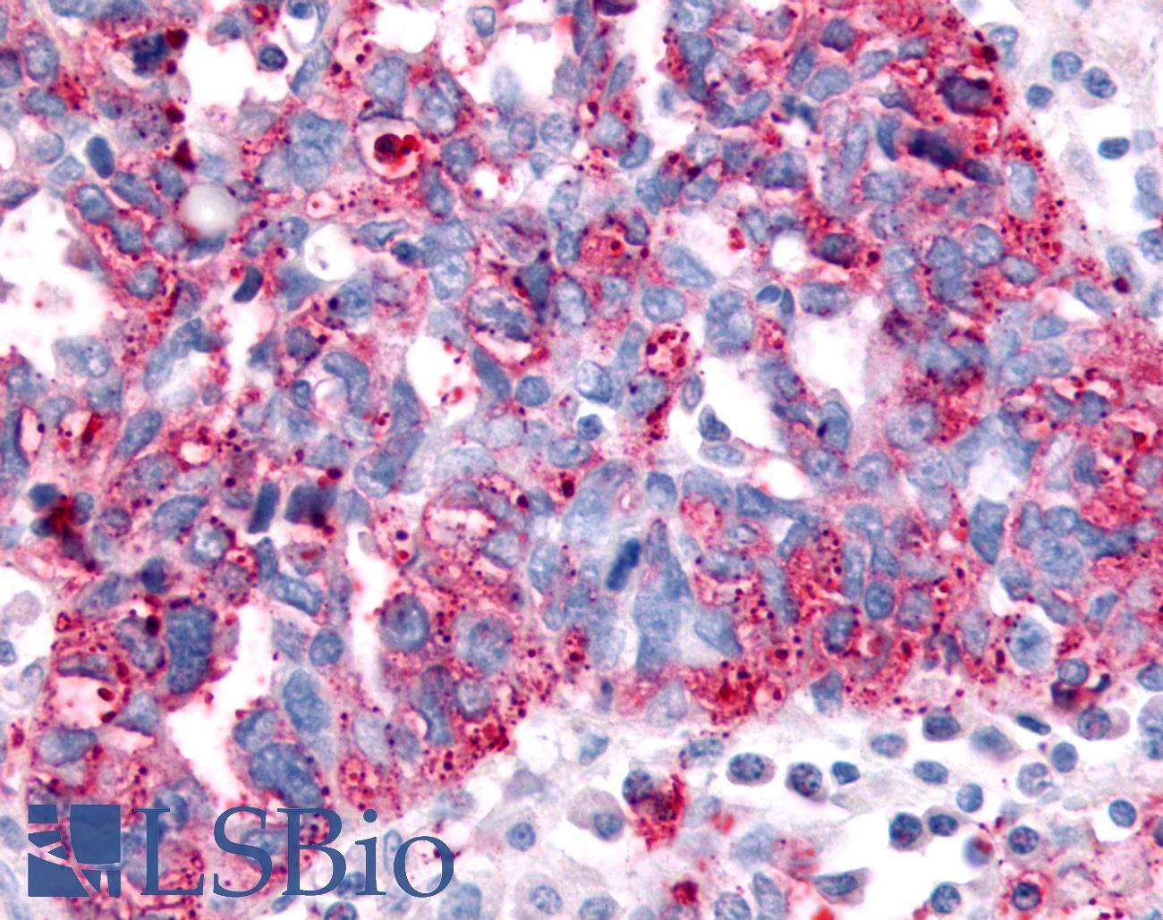 SGK2 Antibody - Ovary, Carcinoma