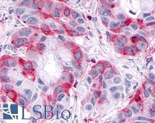 SGK3 Antibody - Anti-SGK3 antibody IHC of human Pancreas, Carcinoma. Immunohistochemistry of formalin-fixed, paraffin-embedded tissue after heat-induced antigen retrieval.