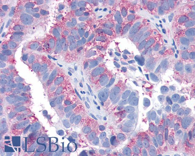 SIPR3 / EDG3 / S1P3 Antibody - Ovary, carcinoma