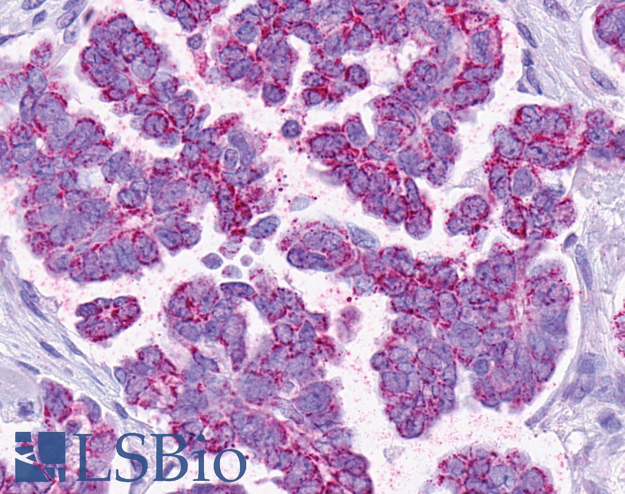 SMO / Smoothened Antibody - Ovary, Carcinoma