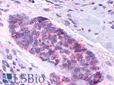 SMO / Smoothened Antibody - Skin, Basal Cell Carcinoma