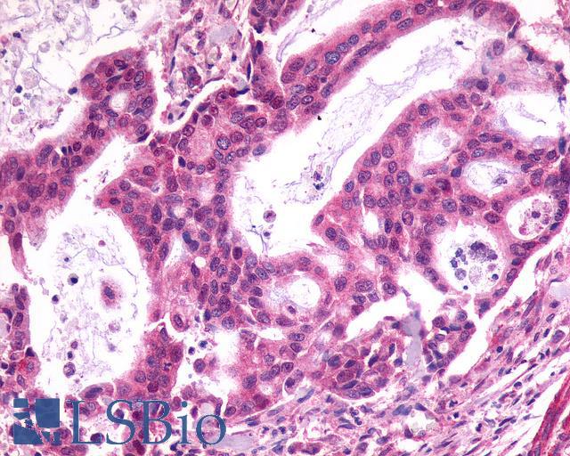 SSTR1 Antibody - Pancreas, carcinoma