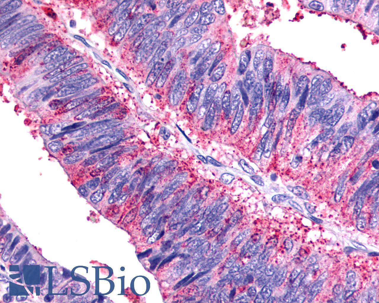 SSTR1 Antibody - Colon, Carcinoma