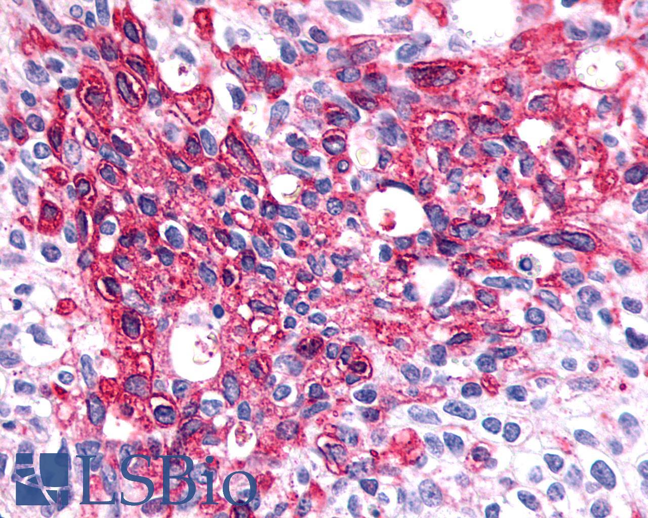 SSTR1 Antibody - Ovary, carcinoma