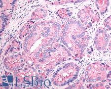 SSTR1 Antibody - Anti-SSTR1 antibody IHC of human Prostate, Carcinoma. Immunohistochemistry of formalin-fixed, paraffin-embedded tissue after heat-induced antigen retrieval.