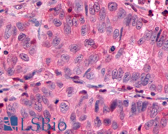 SSTR3 Antibody - Anti-SSTR3 antibody IHC of human Lung, Non-Small Cell Carcinoma. Immunohistochemistry of formalin-fixed, paraffin-embedded tissue after heat-induced antigen retrieval.