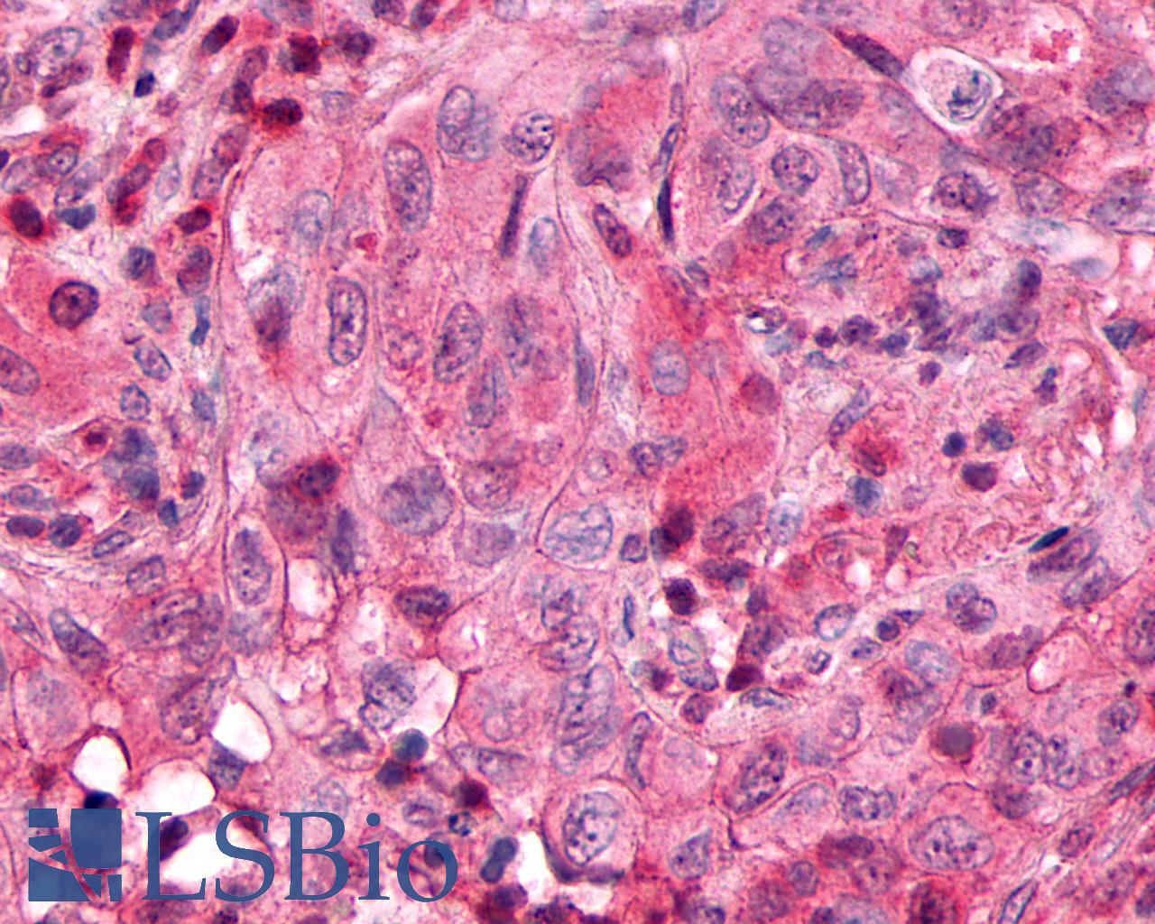 SSTR3 Antibody - Lung, Non Small-Cell Carcinoma