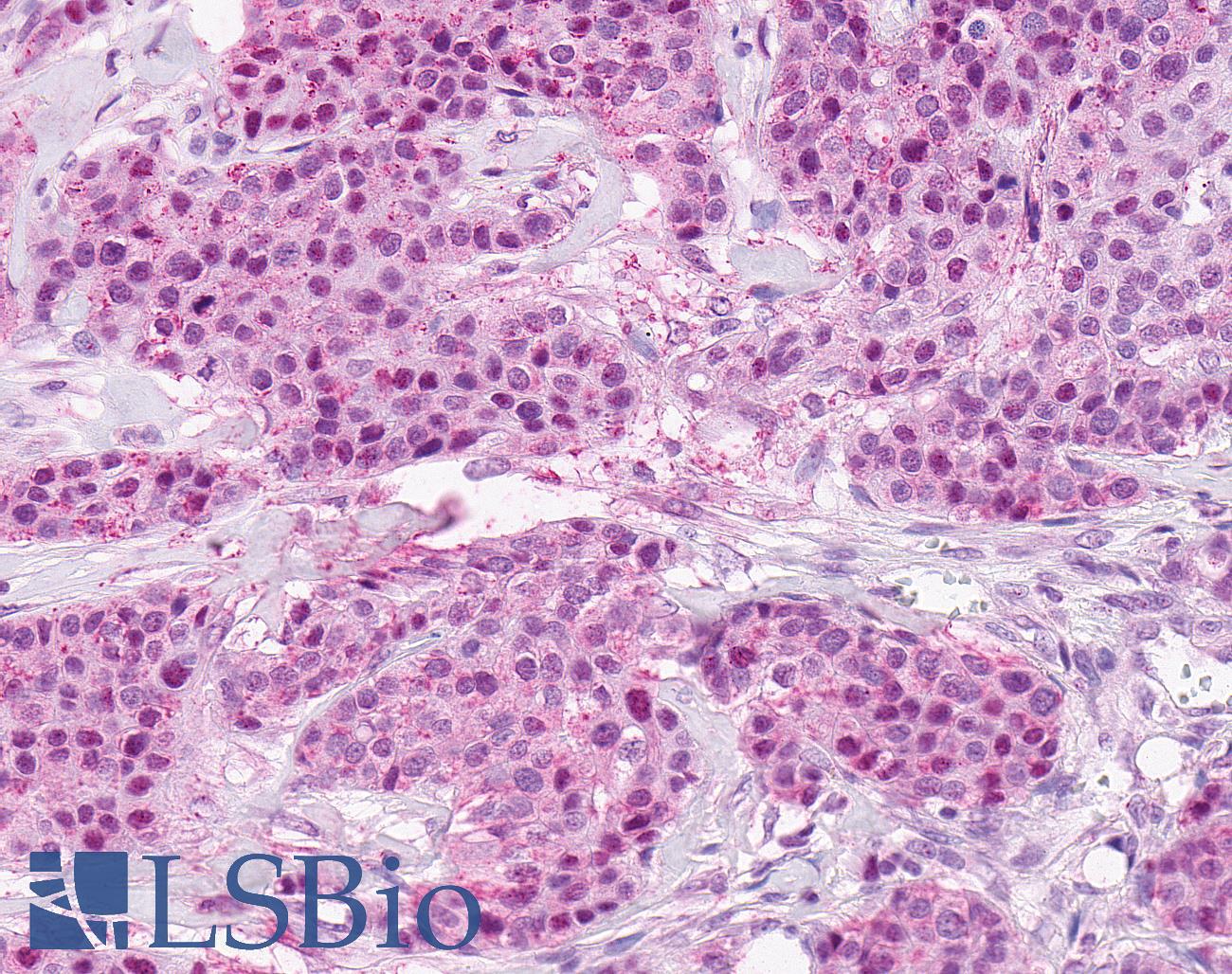 SSTR4 Antibody - Breast, Carcinoma