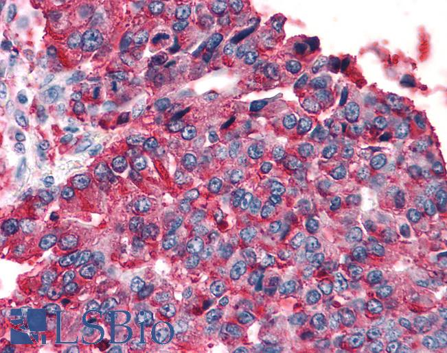 T1R3 / TAS1R3 Antibody - Anti-T1R3 / TAS1R3 antibody IHC of human Lung, Non-Small Cell Carcinoma. Immunohistochemistry of formalin-fixed, paraffin-embedded tissue after heat-induced antigen retrieval.