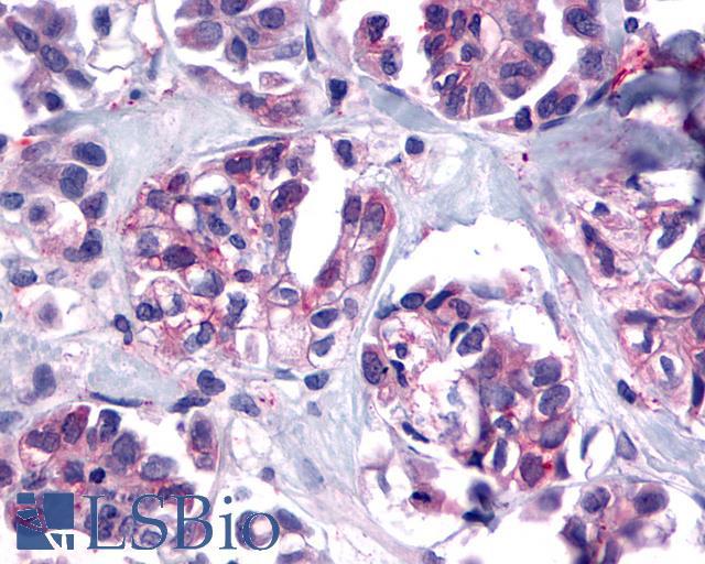 TACR2 / NK2R Antibody - Ovary, carcinoma