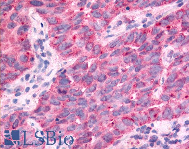 TAOK1 / TAO1 Antibody - Anti-TAOK1 / TAO1 antibody IHC of human Lung, Non-Small Cell Carcinoma. Immunohistochemistry of formalin-fixed, paraffin-embedded tissue after heat-induced antigen retrieval.