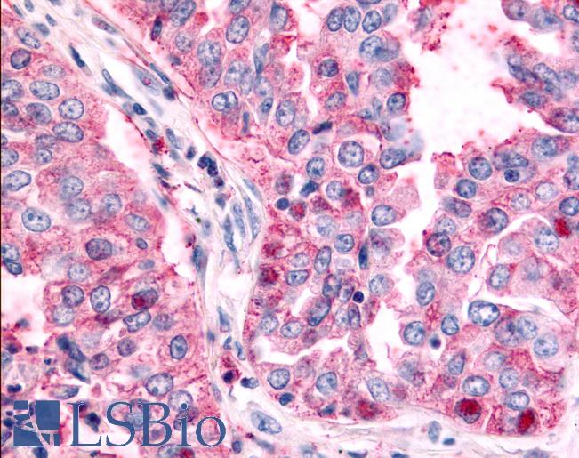 TAOK1 / TAO1 Antibody - Anti-TAOK1 / TAO1 antibody IHC of human Lung, Non-Small Cell Carcinoma. Immunohistochemistry of formalin-fixed, paraffin-embedded tissue after heat-induced antigen retrieval.