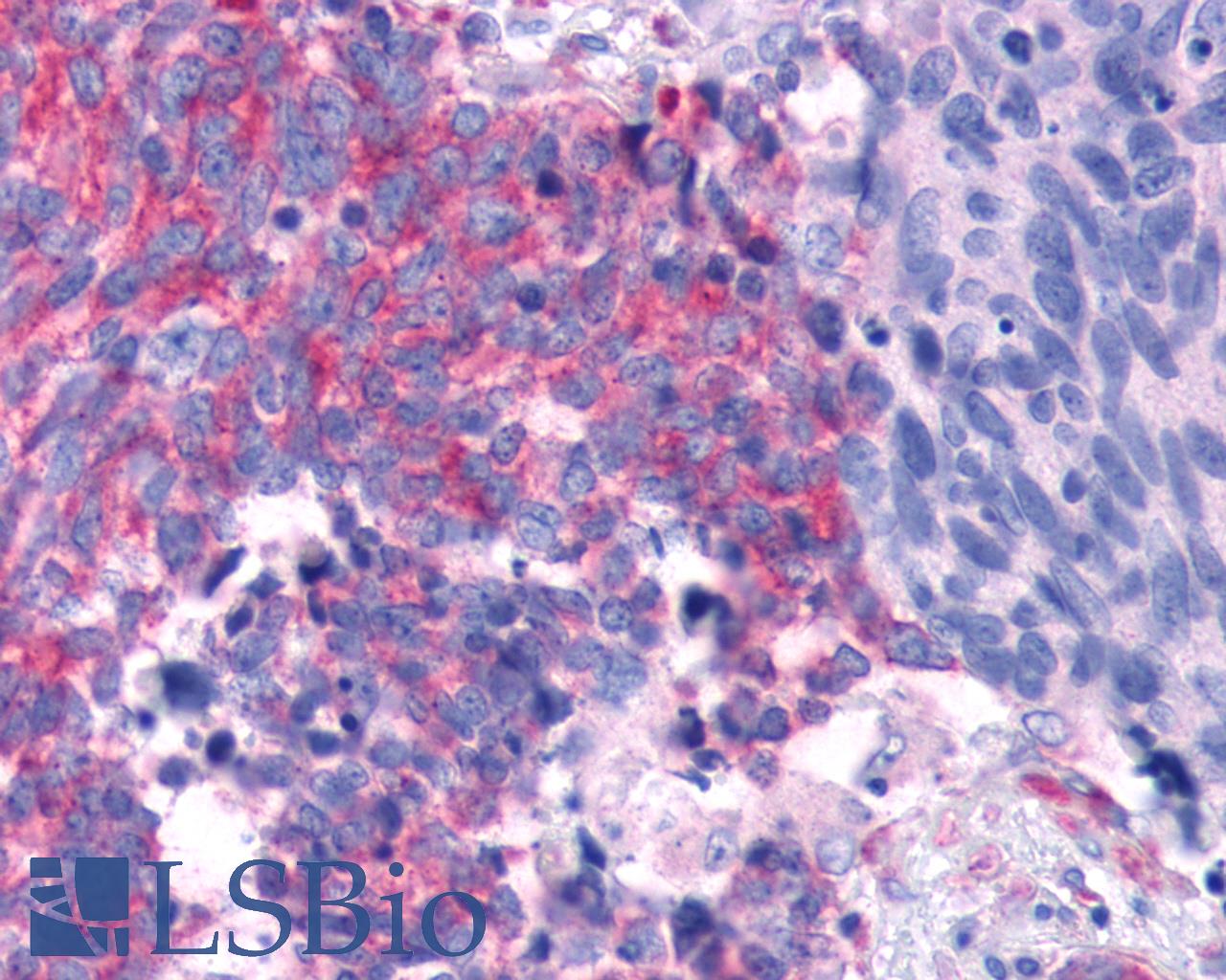 TAS1R2 / T1R2 Antibody - Anti-TAS1R2 / T1R2 antibody IHC of human Lung, Small Cell Carcinoma. Immunohistochemistry of formalin-fixed, paraffin-embedded tissue after heat-induced antigen retrieval.