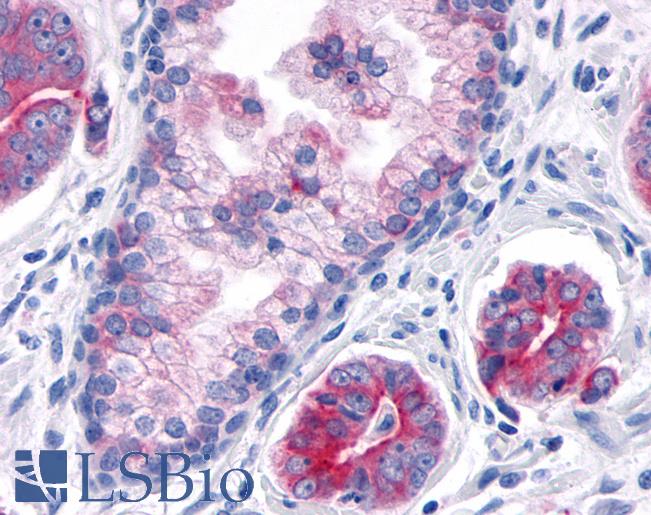 TNIK Antibody - Anti-TNIK antibody IHC of human Prostate, Carcinoma. Immunohistochemistry of formalin-fixed, paraffin-embedded tissue after heat-induced antigen retrieval.