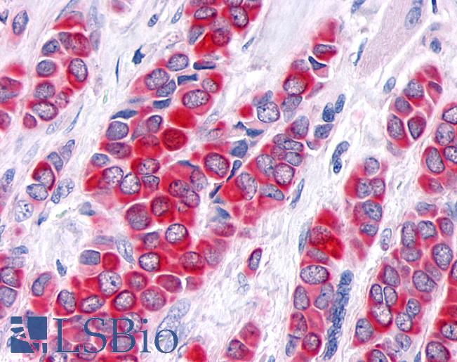 TNIK Antibody - Anti-TNIK antibody IHC of human Breast, Carcinoma. Immunohistochemistry of formalin-fixed, paraffin-embedded tissue after heat-induced antigen retrieval.