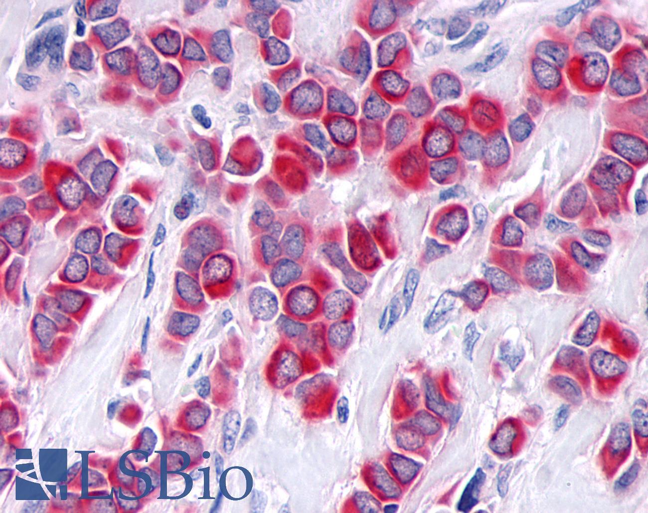 TNIK Antibody - Breast, Carcinoma