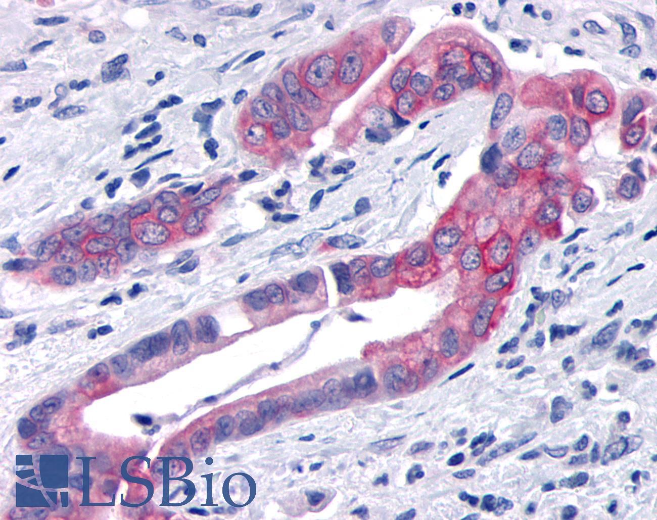 TNIK Antibody - Pancreas, carcinoma