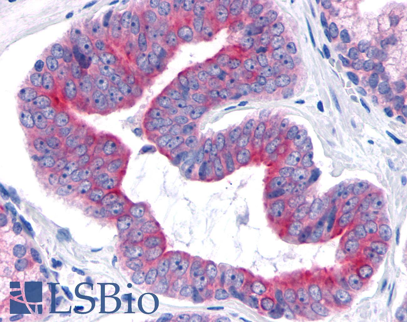 TNIK Antibody - Prostate, Carcinoma