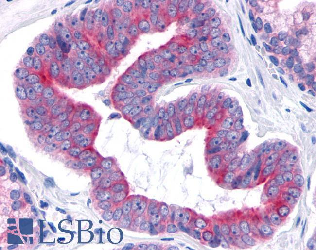 TNIK Antibody - Prostate, Carcinoma