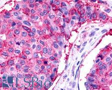 TPRA1 / GPR175 Antibody - Anti-TPRA1 / GPR175 antibody IHC of human Breast, Carcinoma. Immunohistochemistry of formalin-fixed, paraffin-embedded tissue after heat-induced antigen retrieval.