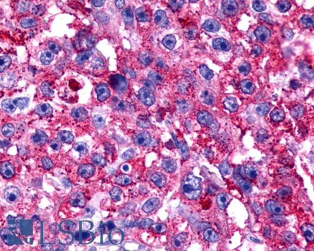 TPRA1 / GPR175 Antibody - Anti-TPRA1 / GPR175 antibody IHC of human Breast, Carcinoma. Immunohistochemistry of formalin-fixed, paraffin-embedded tissue after heat-induced antigen retrieval.