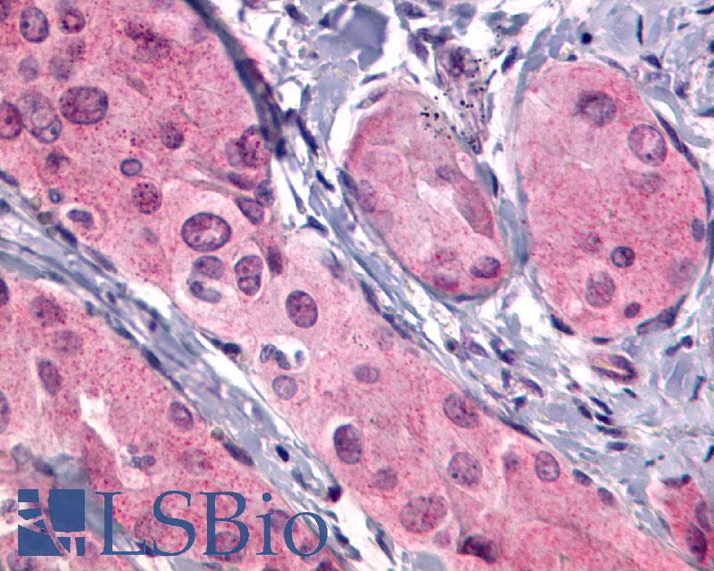 TSH Receptor / TSHR Antibody - Thyroid, Follicular Carcinoma