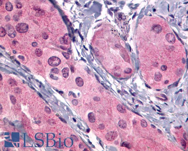 TSH Receptor / TSHR Antibody - Thyroid, Follicular Carcinoma