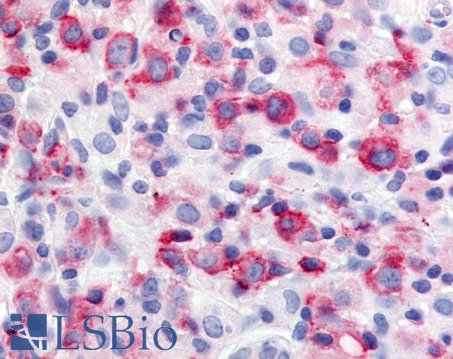 USP20 / VDU2 Antibody - Non-Hodgkin's lymphoma