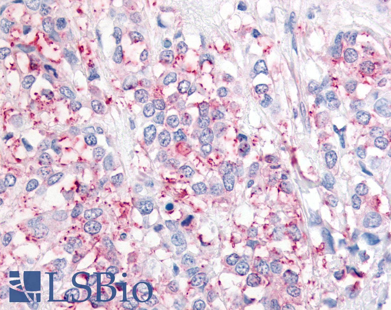 USP20 / VDU2 Antibody - Breast, Carcinoma