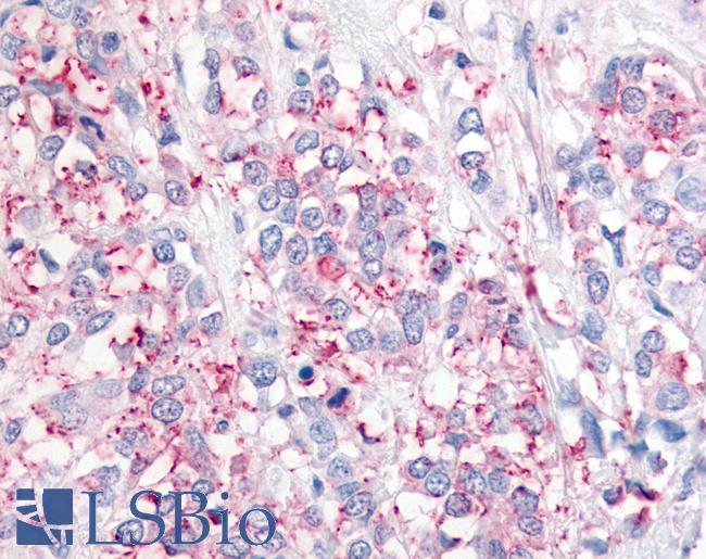 USP20 / VDU2 Antibody - Breast, Carcinoma