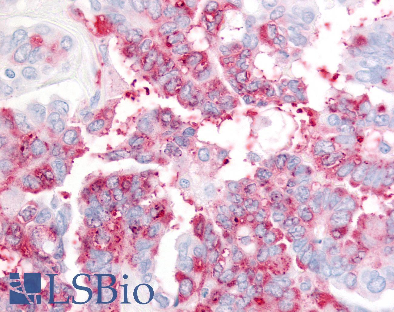 USP20 / VDU2 Antibody - Ovary, Carcinoma