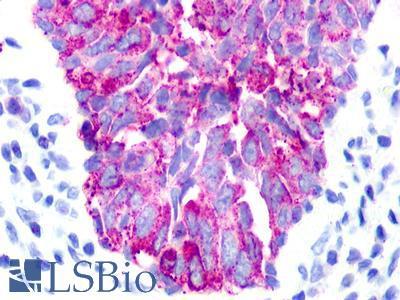UTS2R / GPR14 Antibody - Breast, Carcinoma