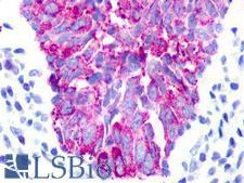 UTS2R / GPR14 Antibody - Breast, Carcinoma
