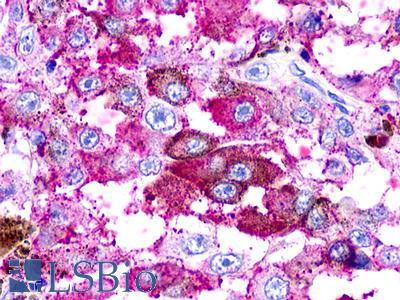 UTS2R / GPR14 Antibody - Skin, Malignant Melanoma