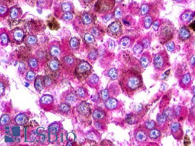 UTS2R / GPR14 Antibody - Skin, Malignant Melanoma
