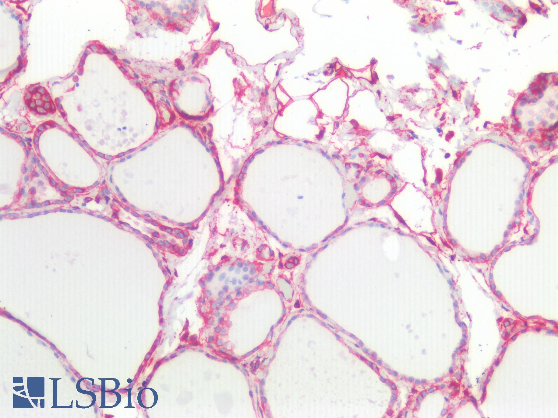 Vimentin Antibody - Human Thyroid: Formalin-Fixed, Paraffin-Embedded (FFPE)