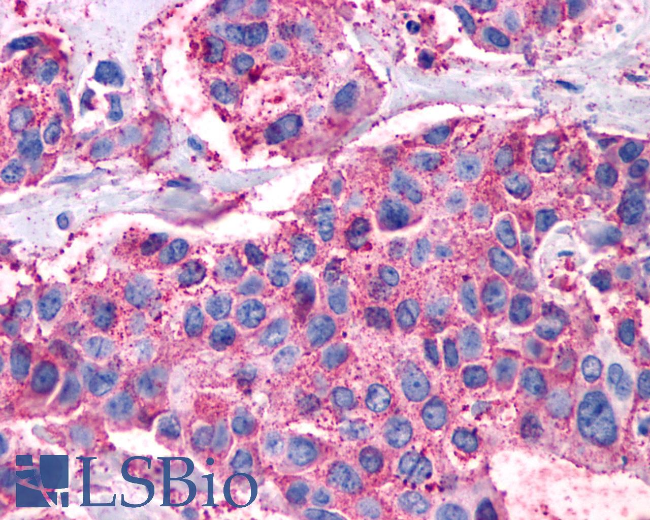 VIPR1 Antibody - Breast carcinoma