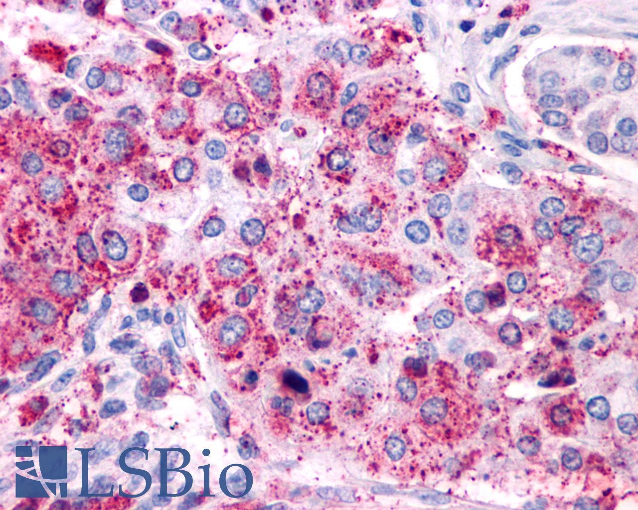 VIPR1 Antibody - Lung, non small-cell carcinoma